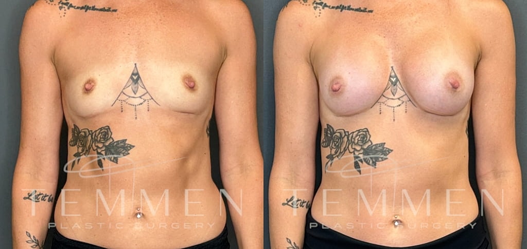 Breast Augmentation Before & After