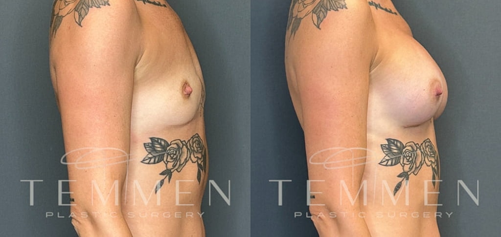 Breast Augmentation Before & After