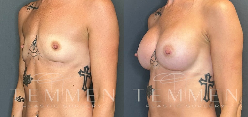 Breast Augmentation Before & After