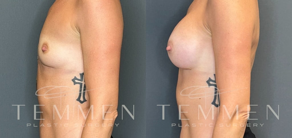 Breast Augmentation Before & After