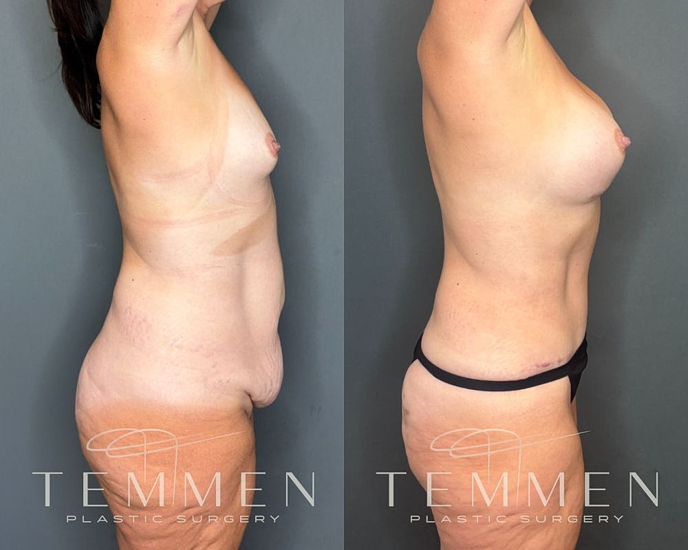 Before and after plastic surgery side view.