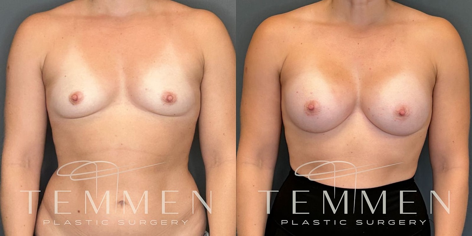 Breast Augmentation Before & After