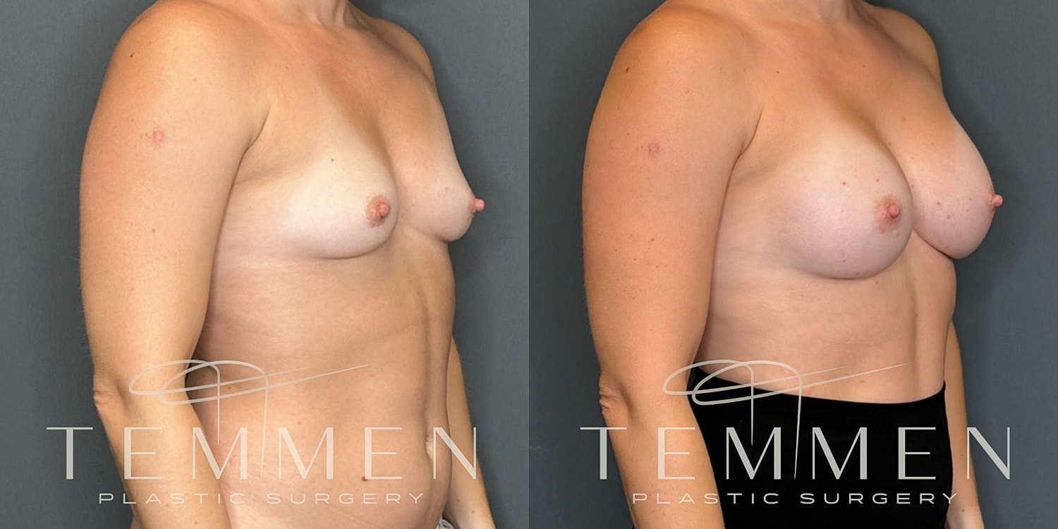 Breast Augmentation Before & After