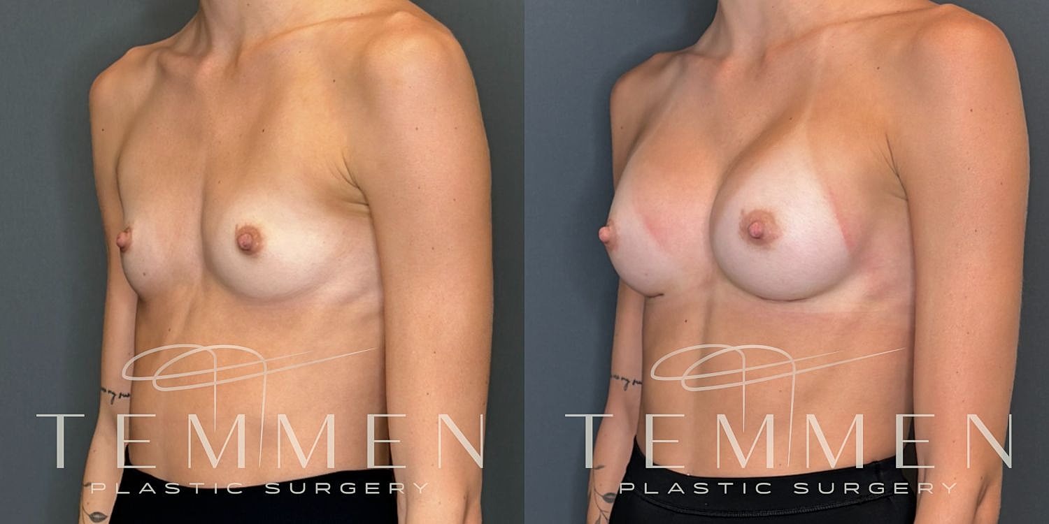 Breast Augmentation Before & After