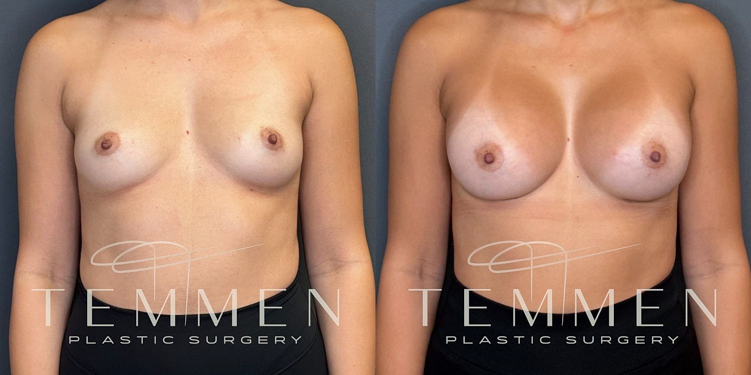 Breast Augmentation Before & After