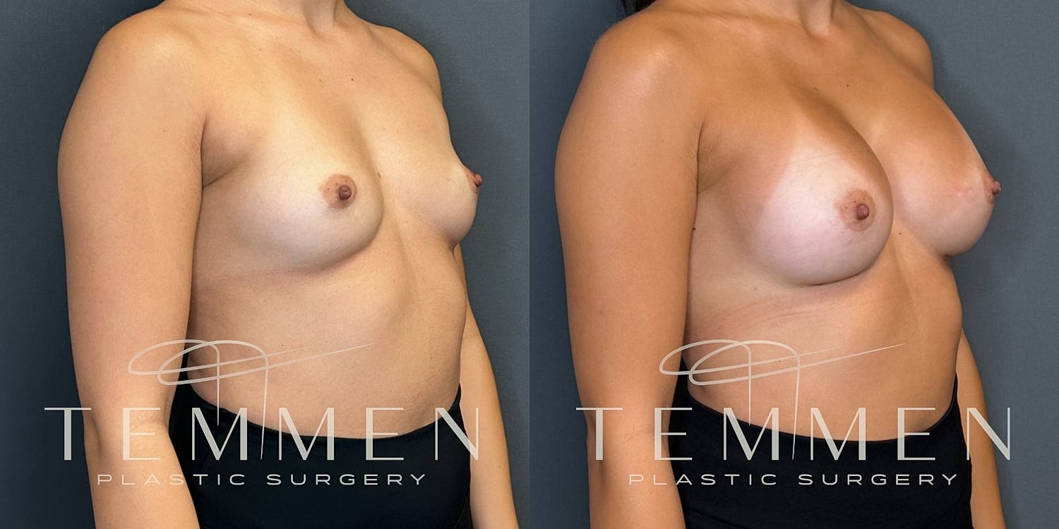 Breast Augmentation Before & After