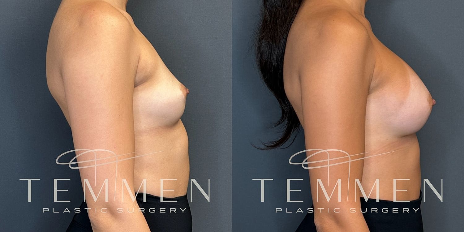 Breast Augmentation Before & After
