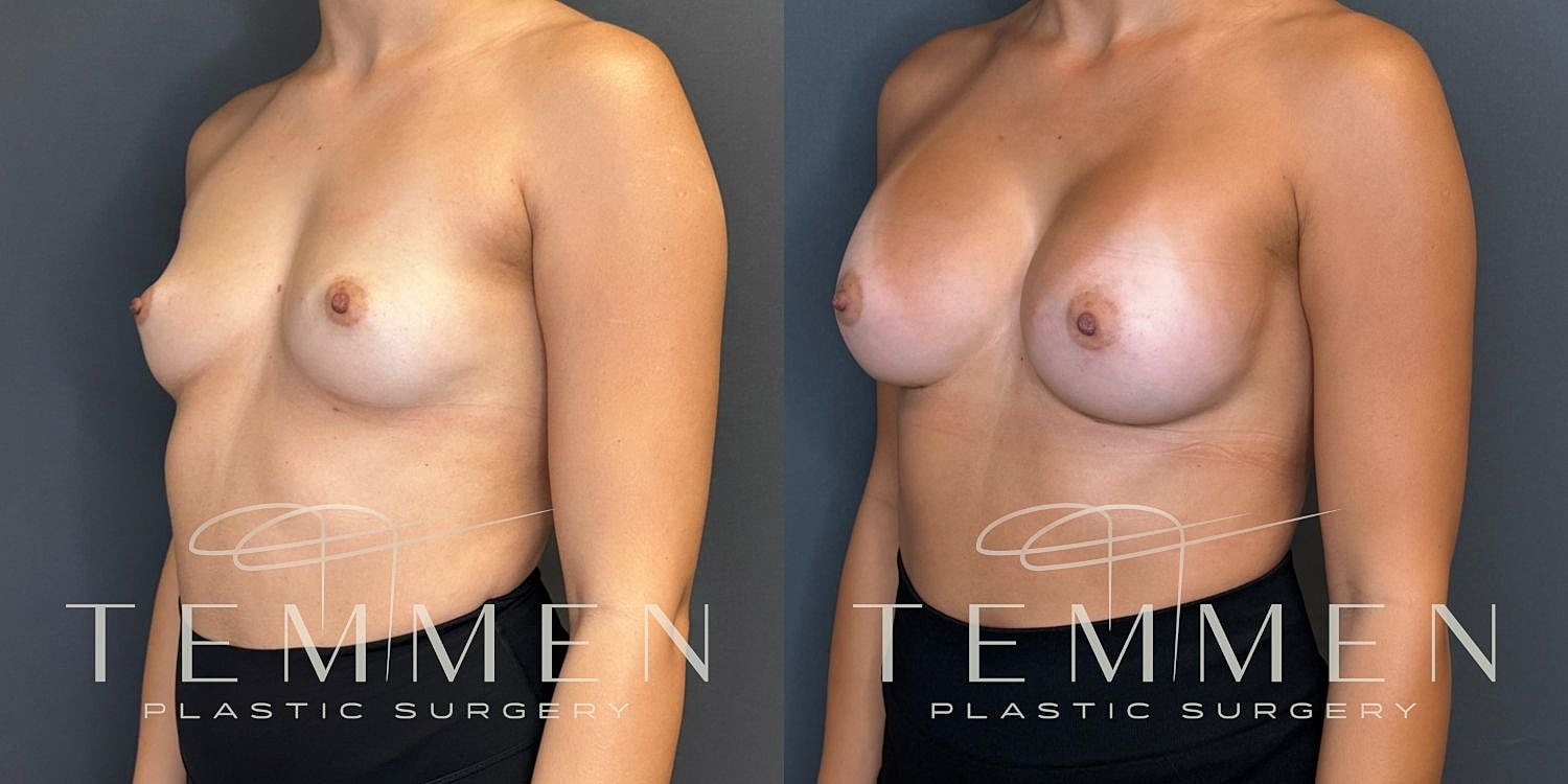 Breast Augmentation Before & After