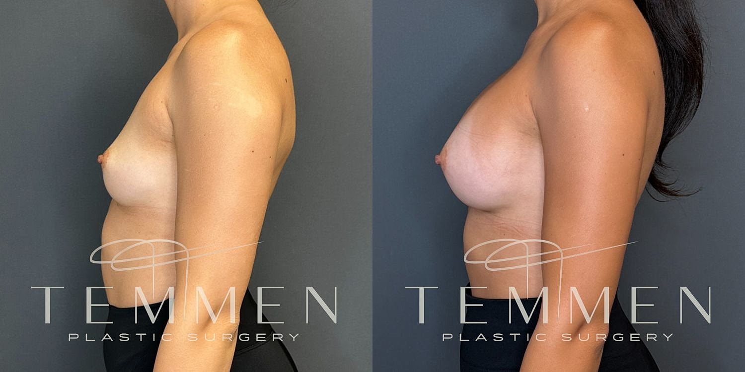 Breast Augmentation Before & After