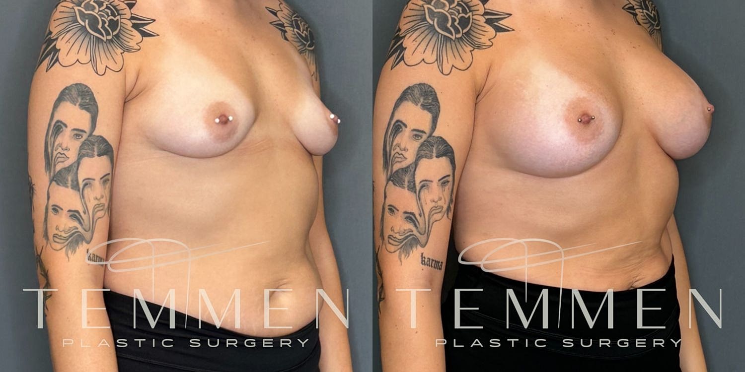 Breast Augmentation Before & After