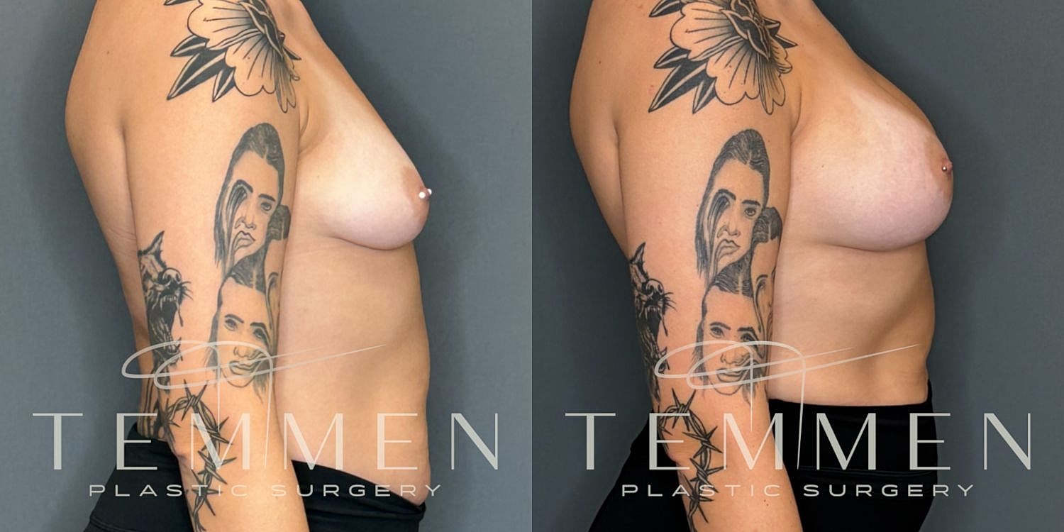 Breast Augmentation Before & After