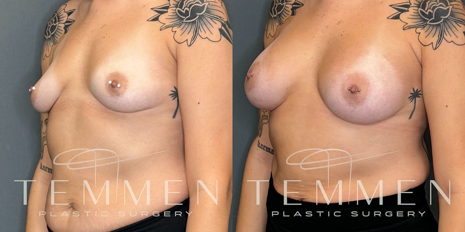 Breast Augmentation Before & After
