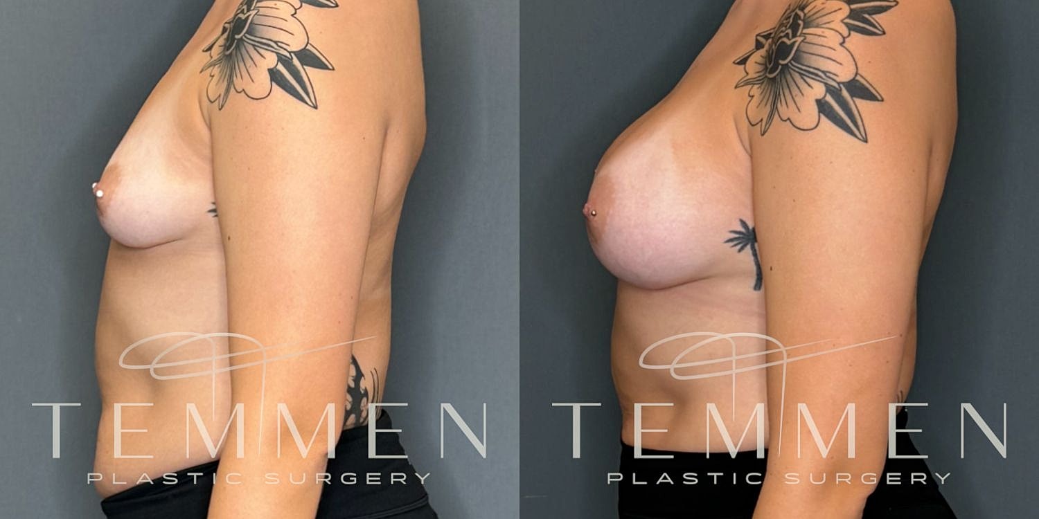 Breast Augmentation Before & After