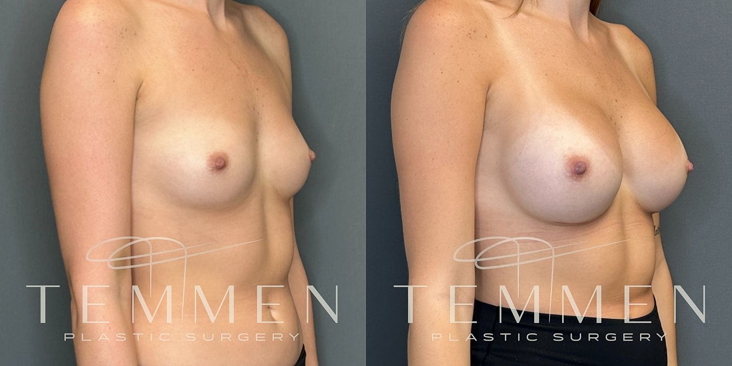 Breast Augmentation Before & After
