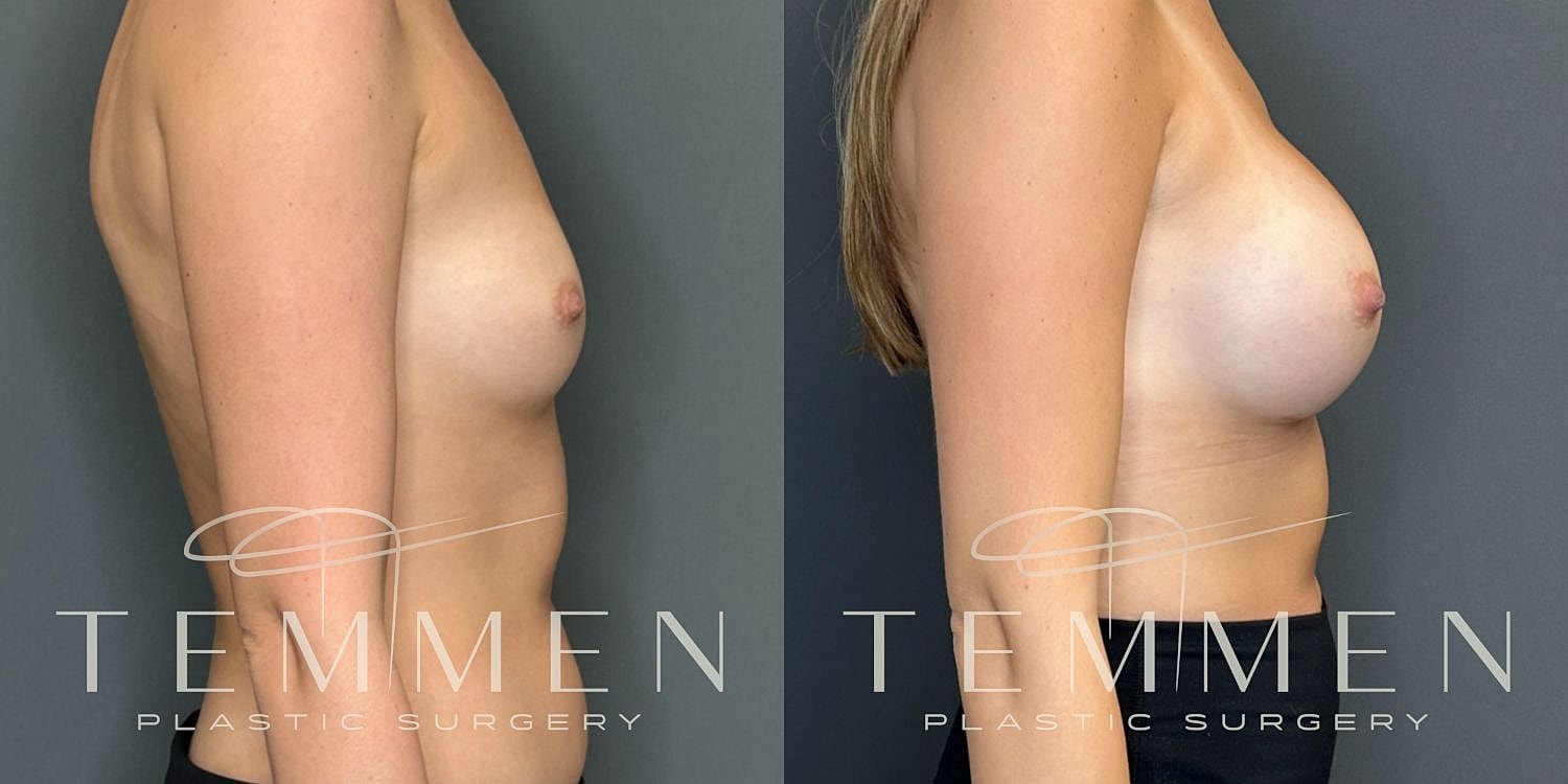 Breast Augmentation Before & After