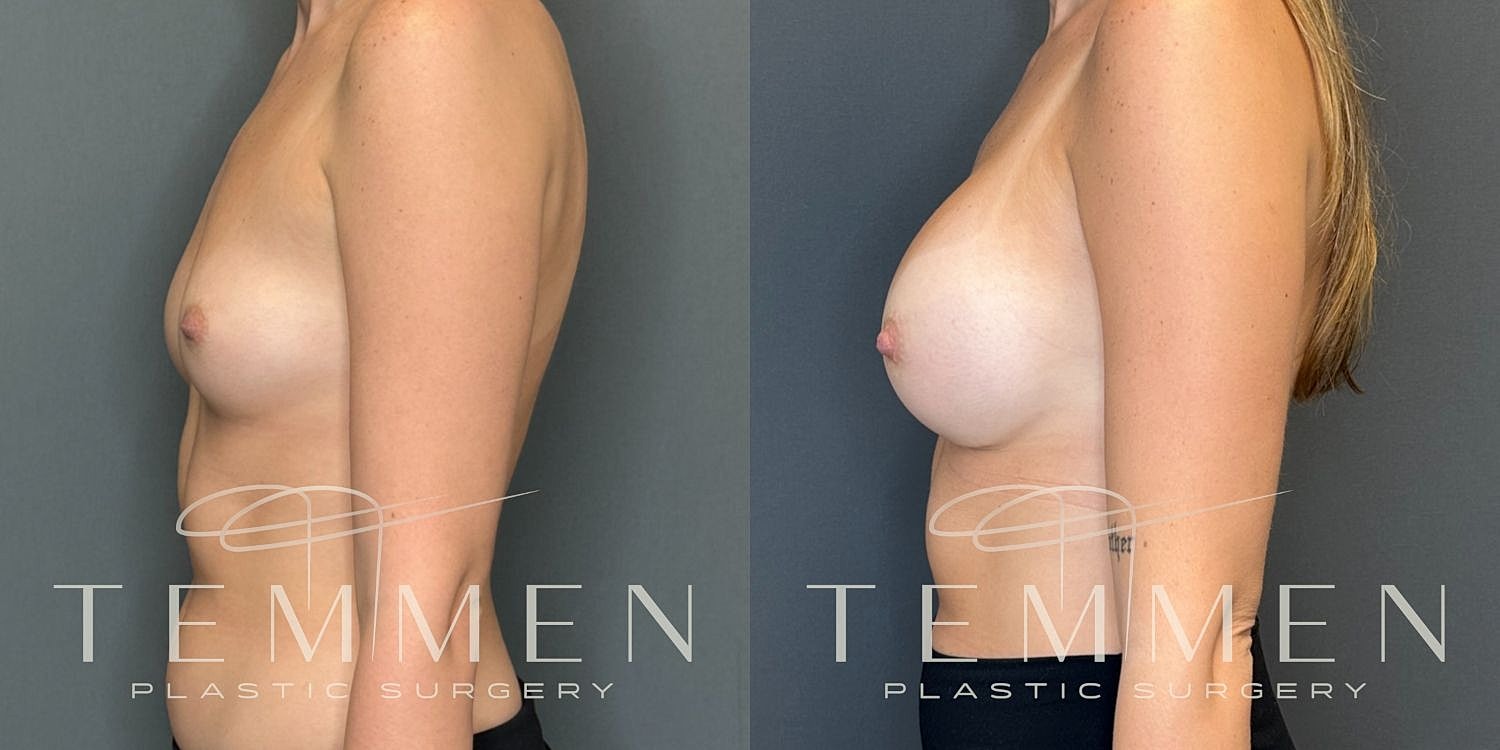 Breast Augmentation Before & After
