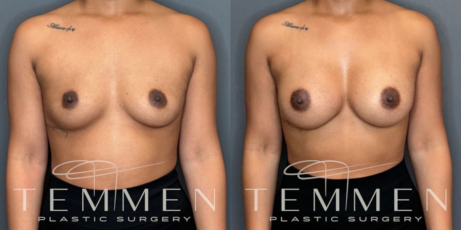 Breast Augmentation Before & After