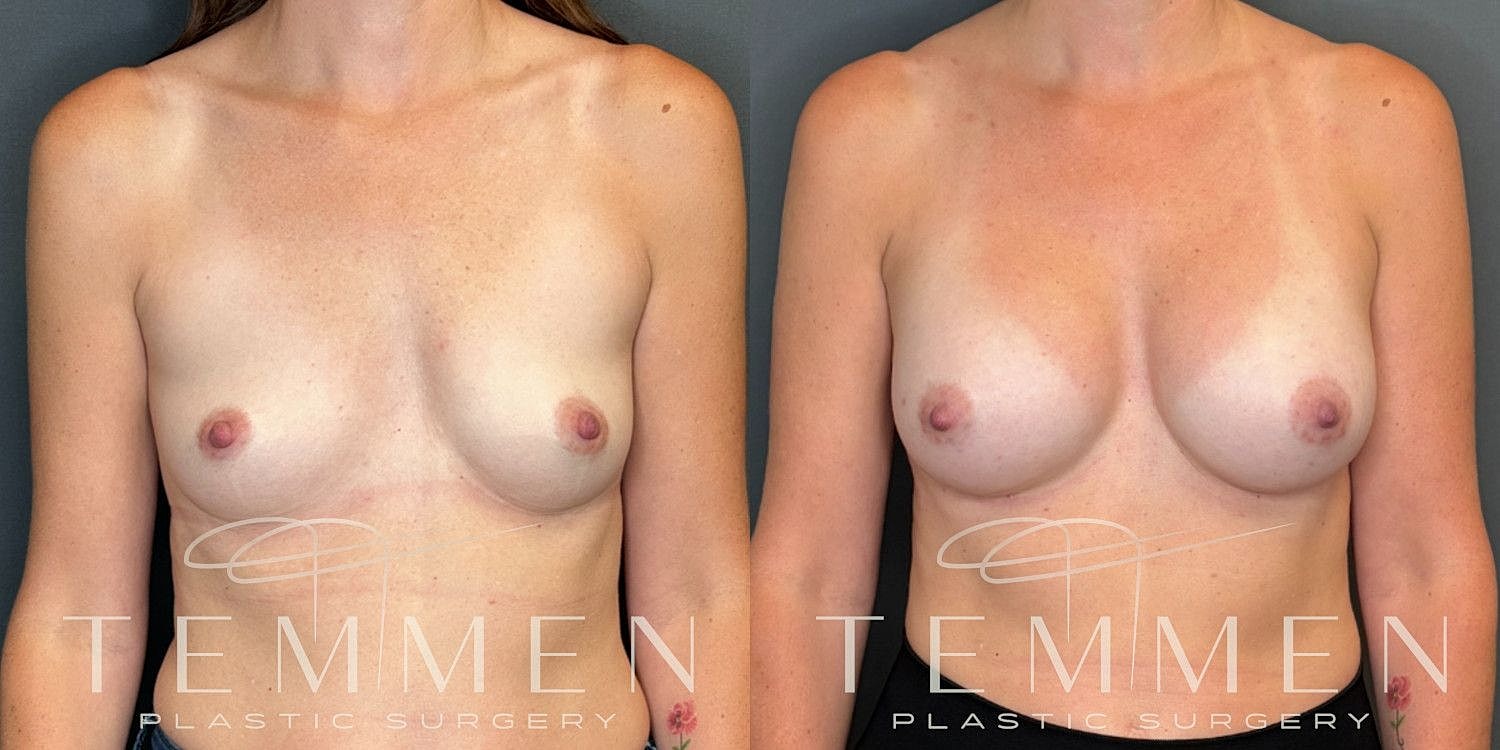 Breast Augmentation Before & After