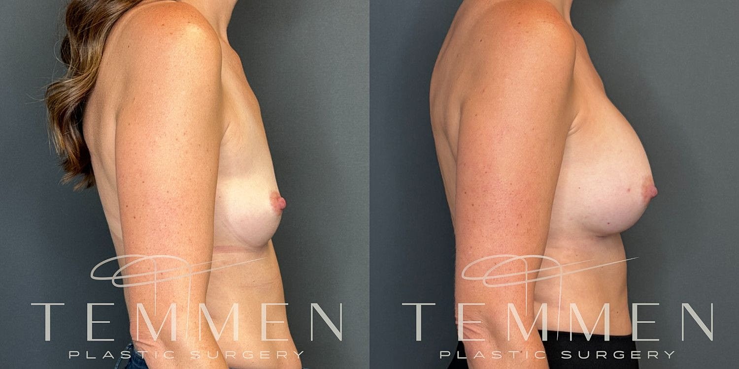 Breast Augmentation Before & After