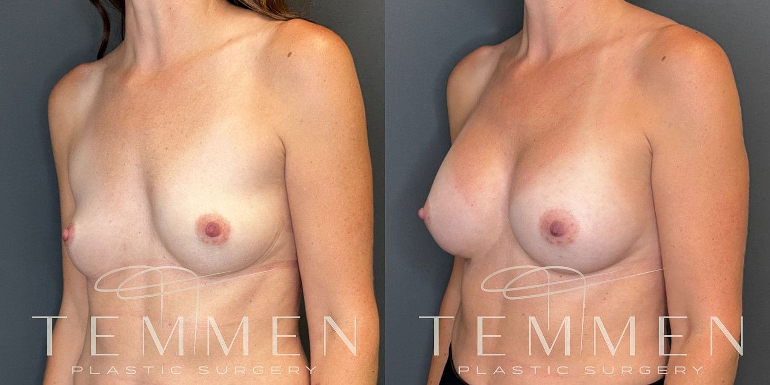 Breast Augmentation Before & After