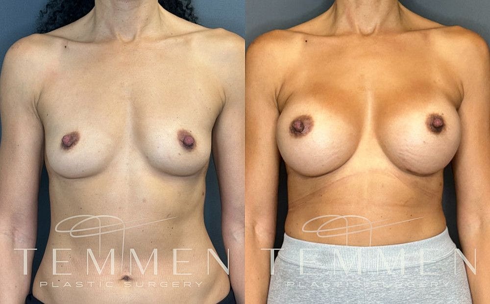 Breast Augmentation Before & After