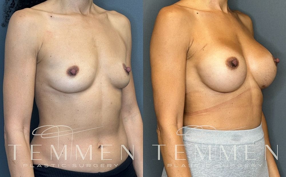 Breast Augmentation Before & After