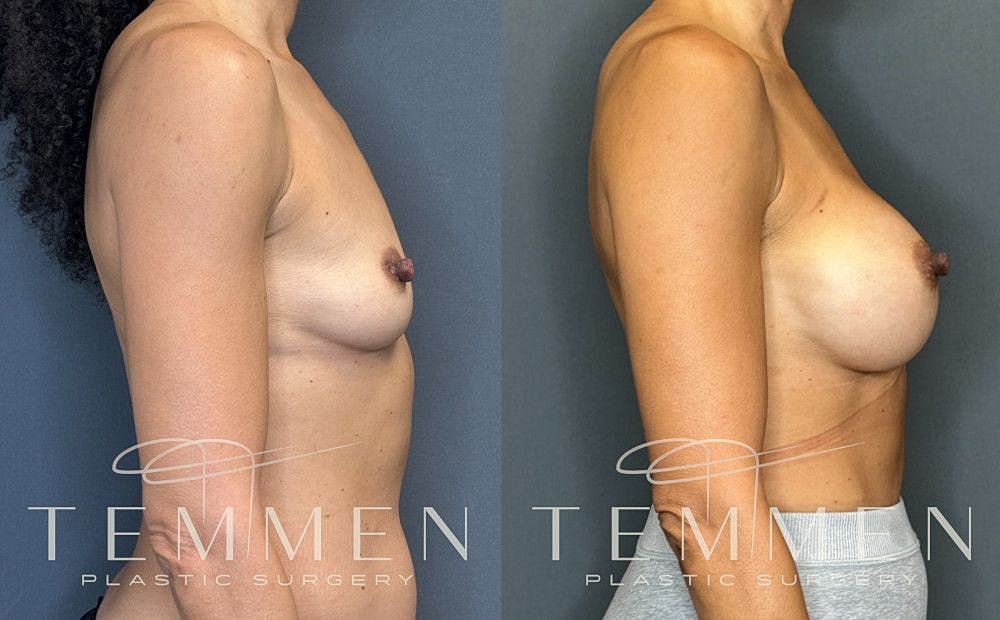 Breast Augmentation Before & After