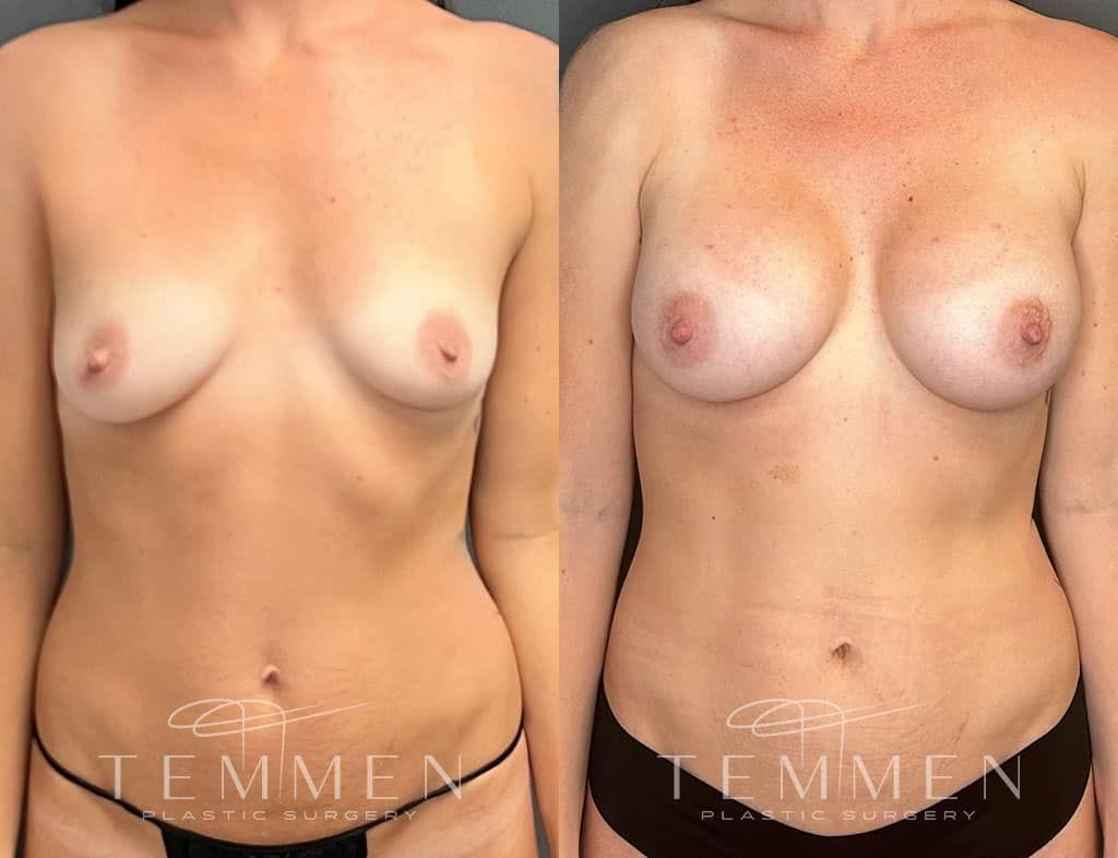 Breast Augmentation Before & After