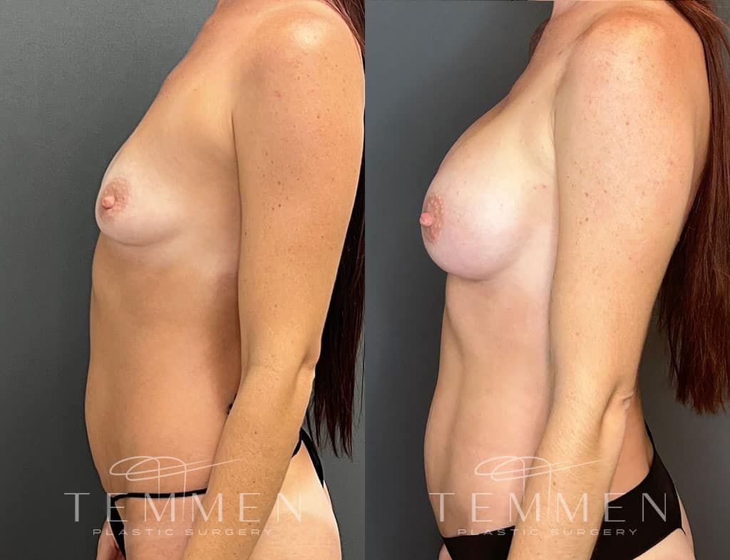 Breast Augmentation Before & After
