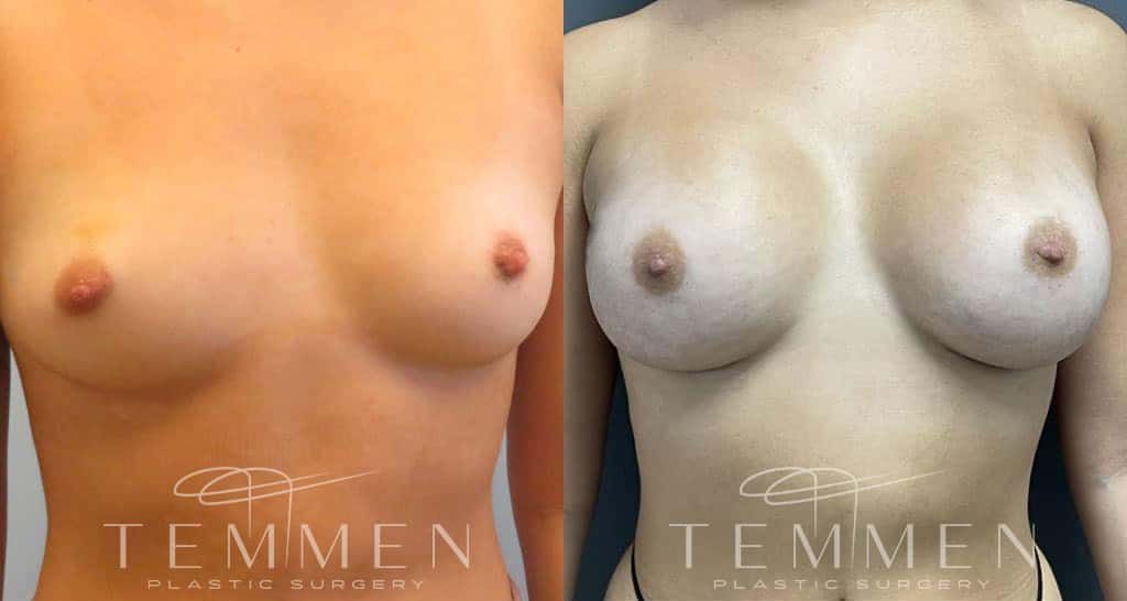 Breast Augmentation Before & After