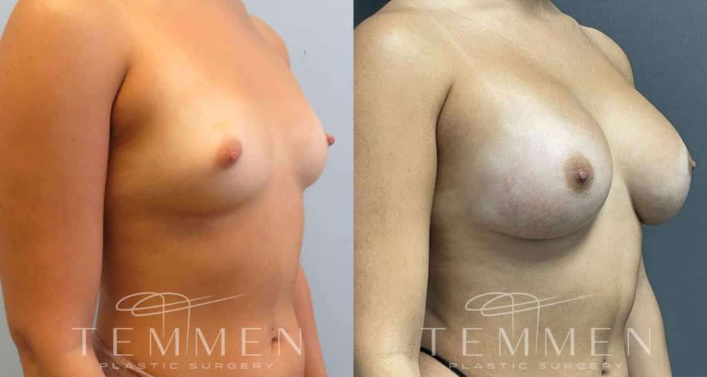 Breast Augmentation Before & After