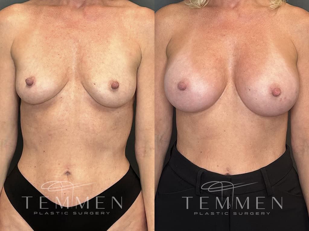 Breast Augmentation Before & After