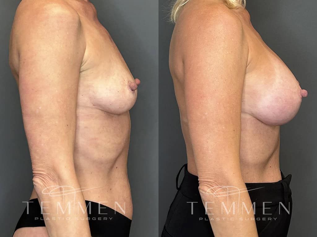 Breast Augmentation Before & After