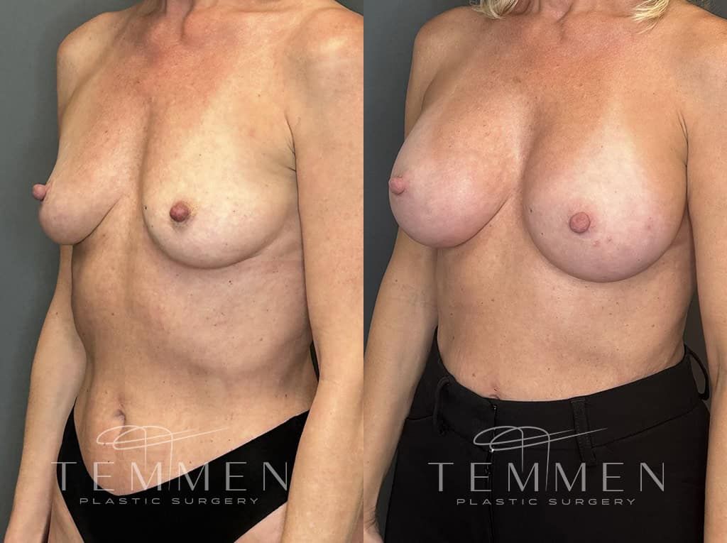 Breast Augmentation Before & After