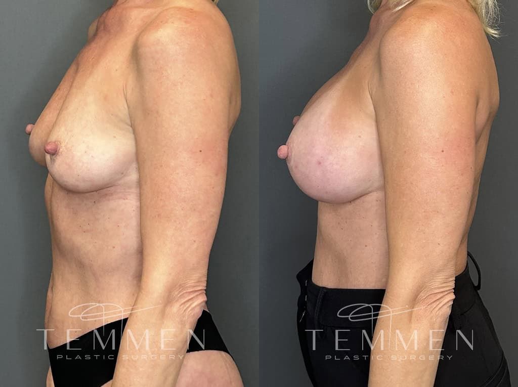 Breast Augmentation Before & After