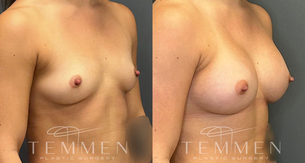 Breast Augmentation Before & After