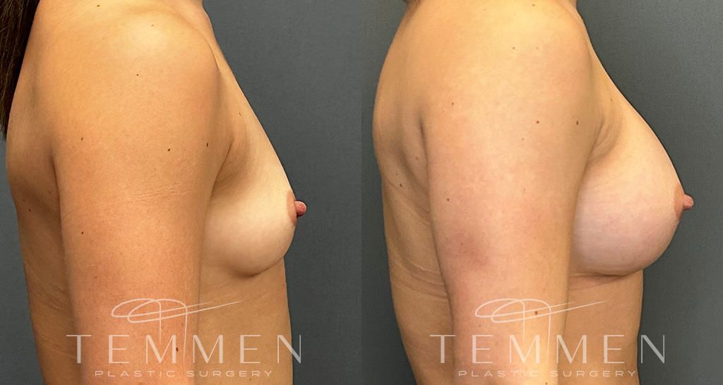 Breast Augmentation Before & After
