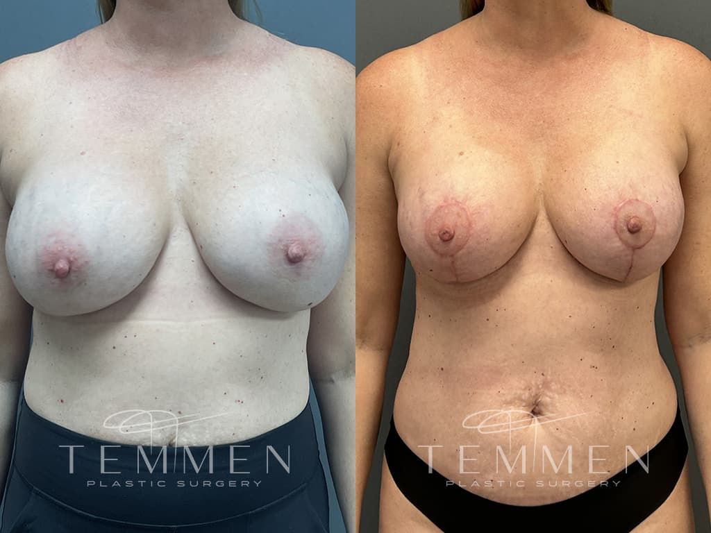 Breast Augmentation Revision Before & After