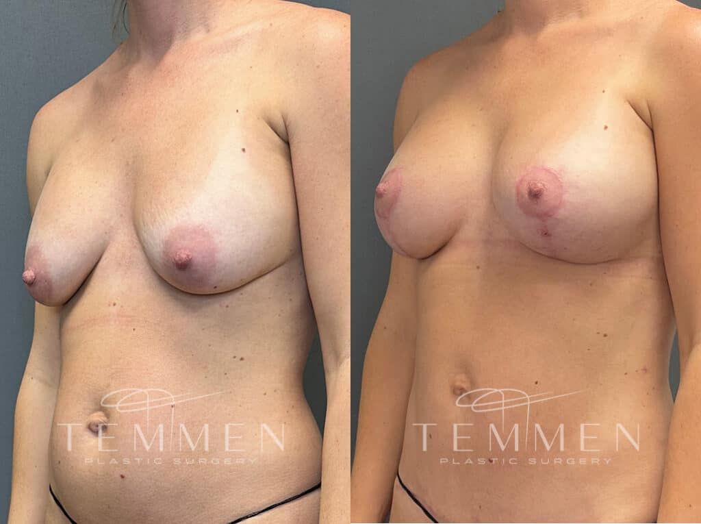 Breast Augmentation Revision Before & After