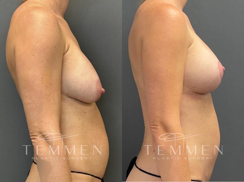 Breast Augmentation Revision Before & After