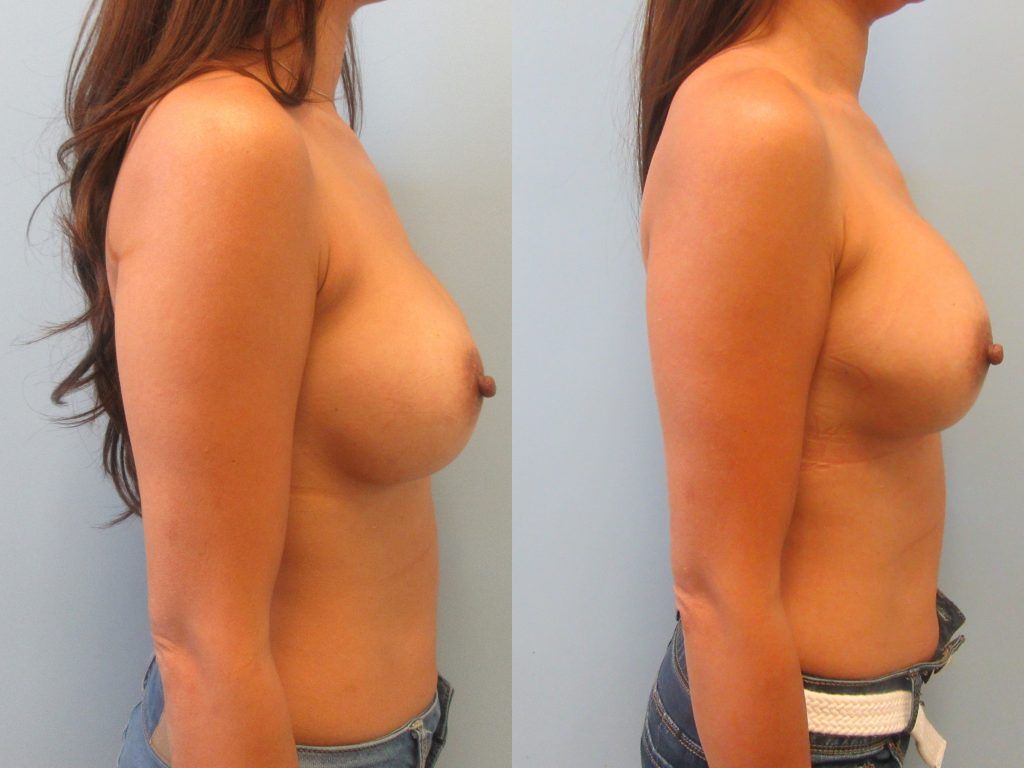 Breast Augmentation Revision Before & After