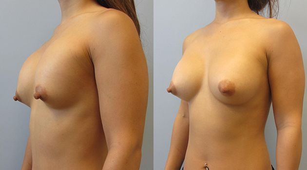 Breast Augmentation Revision Before & After