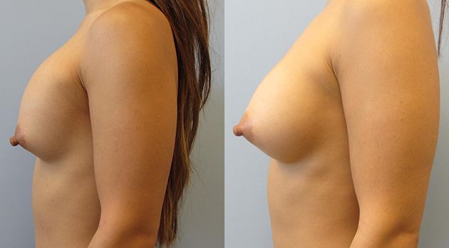 Breast Augmentation Revision Before & After