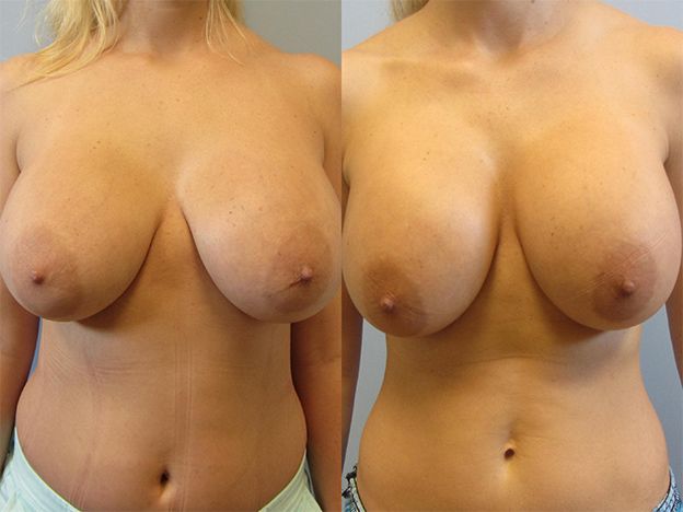 Breast Augmentation Revision Before & After