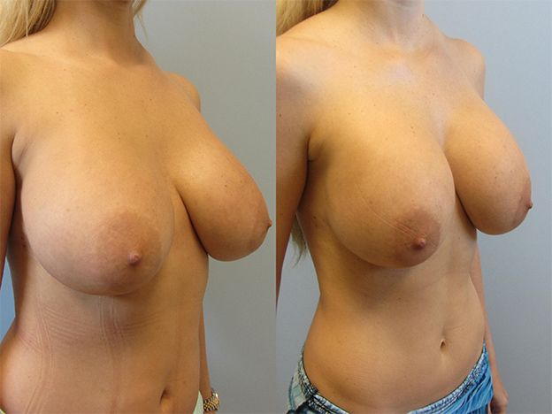 Breast Augmentation Revision Before & After