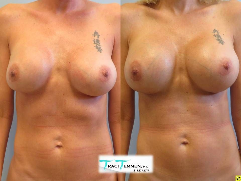 Breast Augmentation Revision Before & After