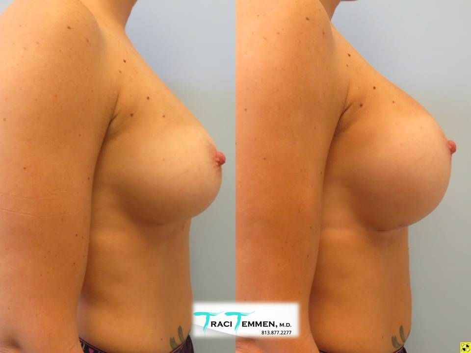 Breast Augmentation Revision Before & After