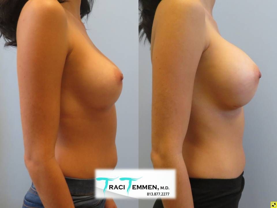 Breast Augmentation Revision Before & After