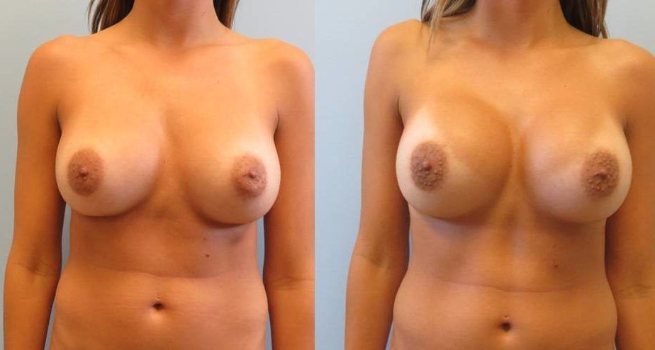 Breast Augmentation Revision Before & After