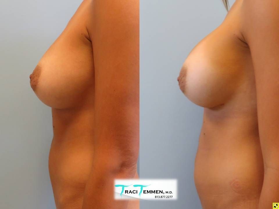 Breast Augmentation Revision Before & After